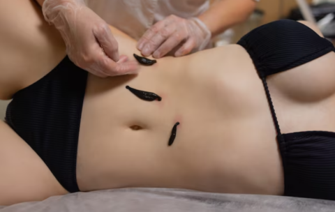 Гирудотерапия – общий курс